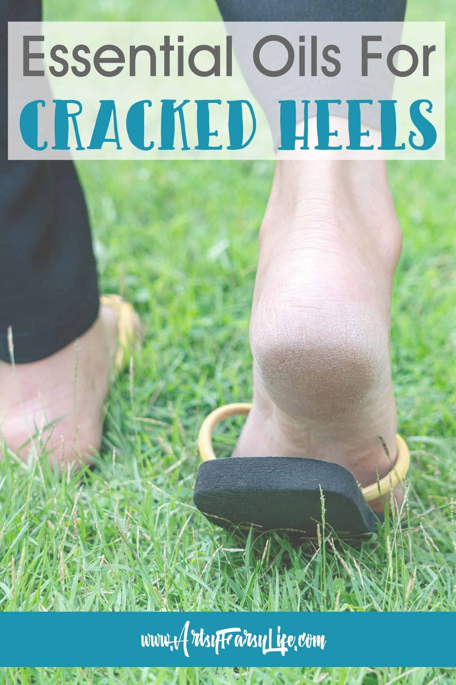 What Causes Cracked Heels? | Gulf Coast Foot and Ankle Specialist